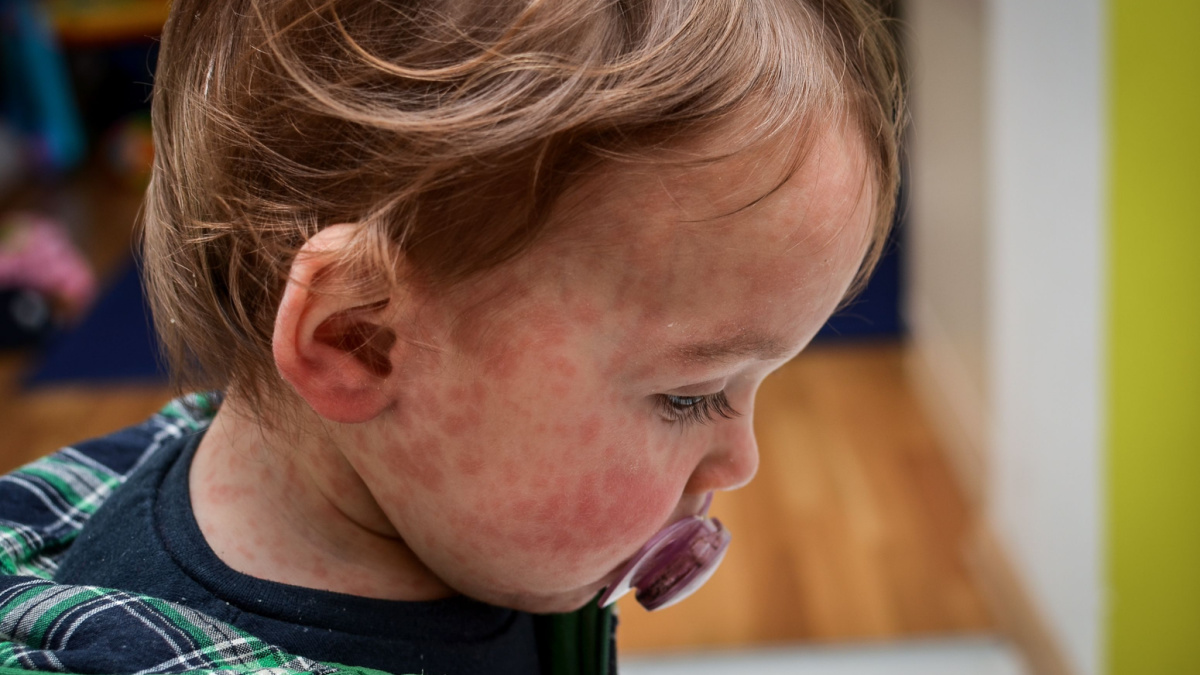 Baby with measles